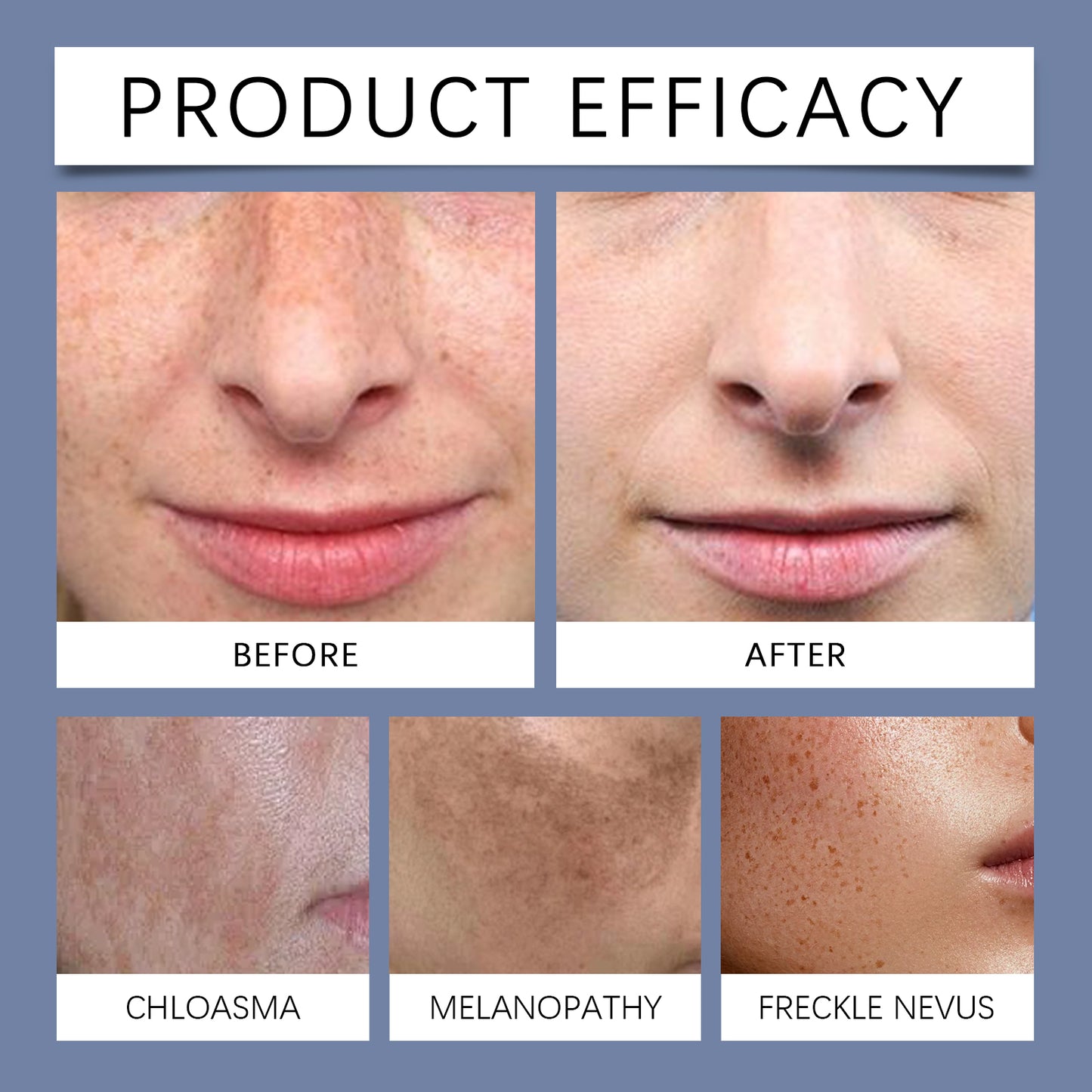 ⭐OUHOE Dark Spot Correcting Cream 🔥Removes All Types of Dark Spots -OKL