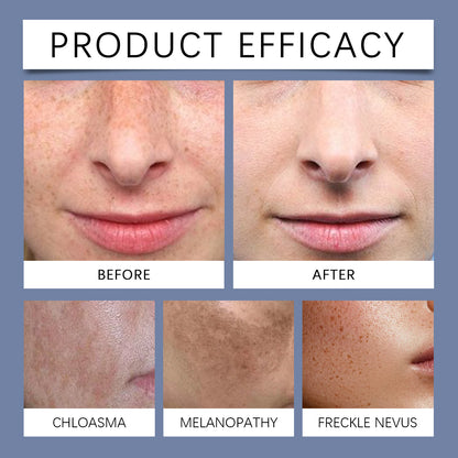 ⭐OUHOE Dark Spot Correcting Cream 🔥Removes All Types of Dark Spots -OKL